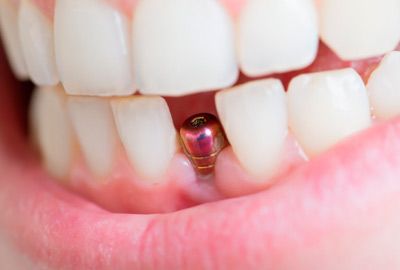 MK Dental implante dental